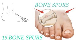 Bone Spurs (Neck And Knee) Natural Treatments