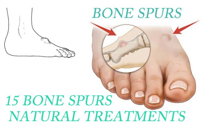 15 Bone Spurs Neck And Knee Natural Treatments That Work 0631