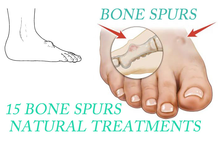 15 Bone Spurs (Neck And Knee) Natural 