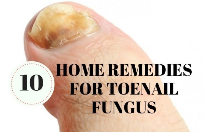 10 Simple And Natural Home Remedies For Toenail Fungus   Home Remedies For Toenail Fungus Cure 681x441 